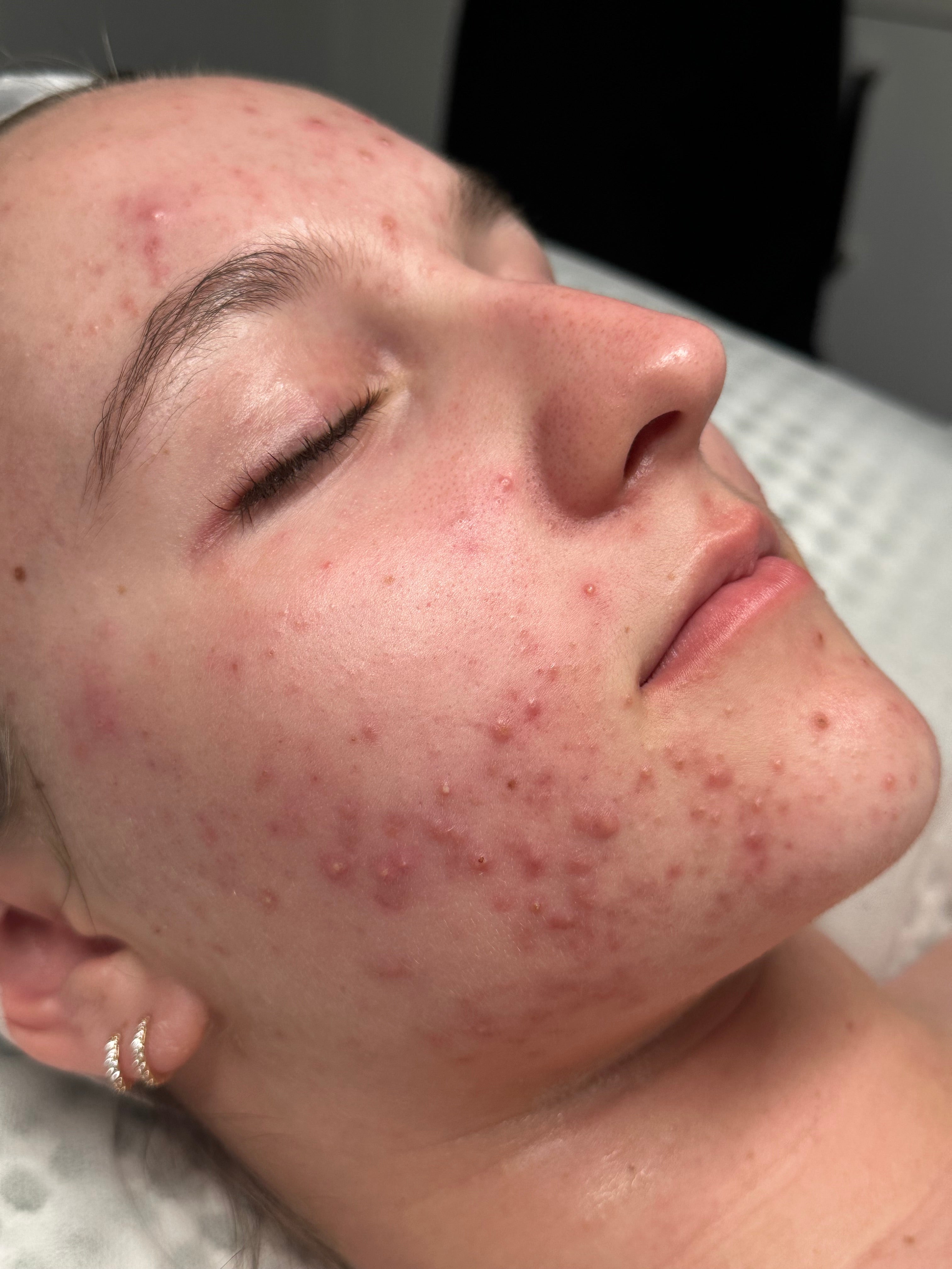 Acne and breakouts