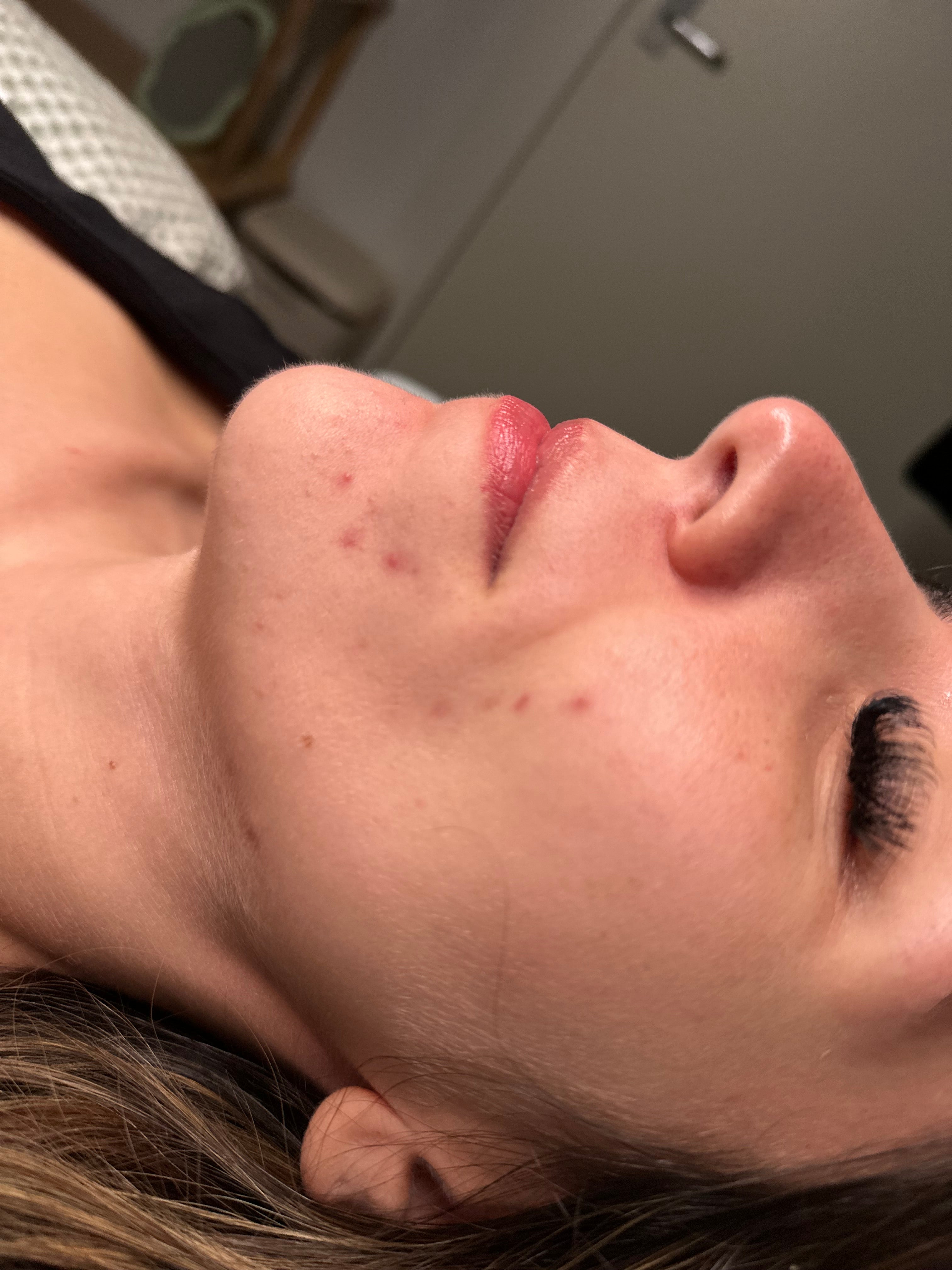 Acne scarring and texture