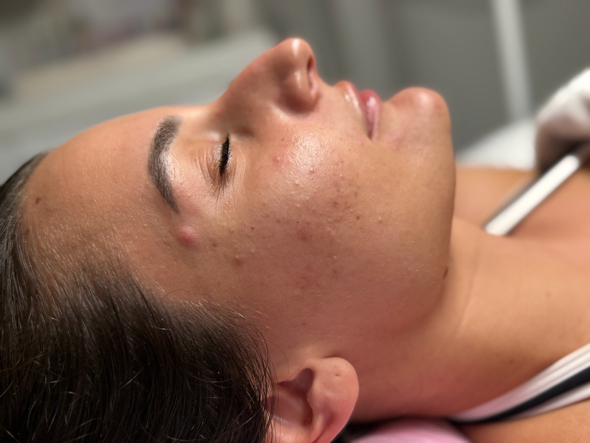 Impaired skin barriers