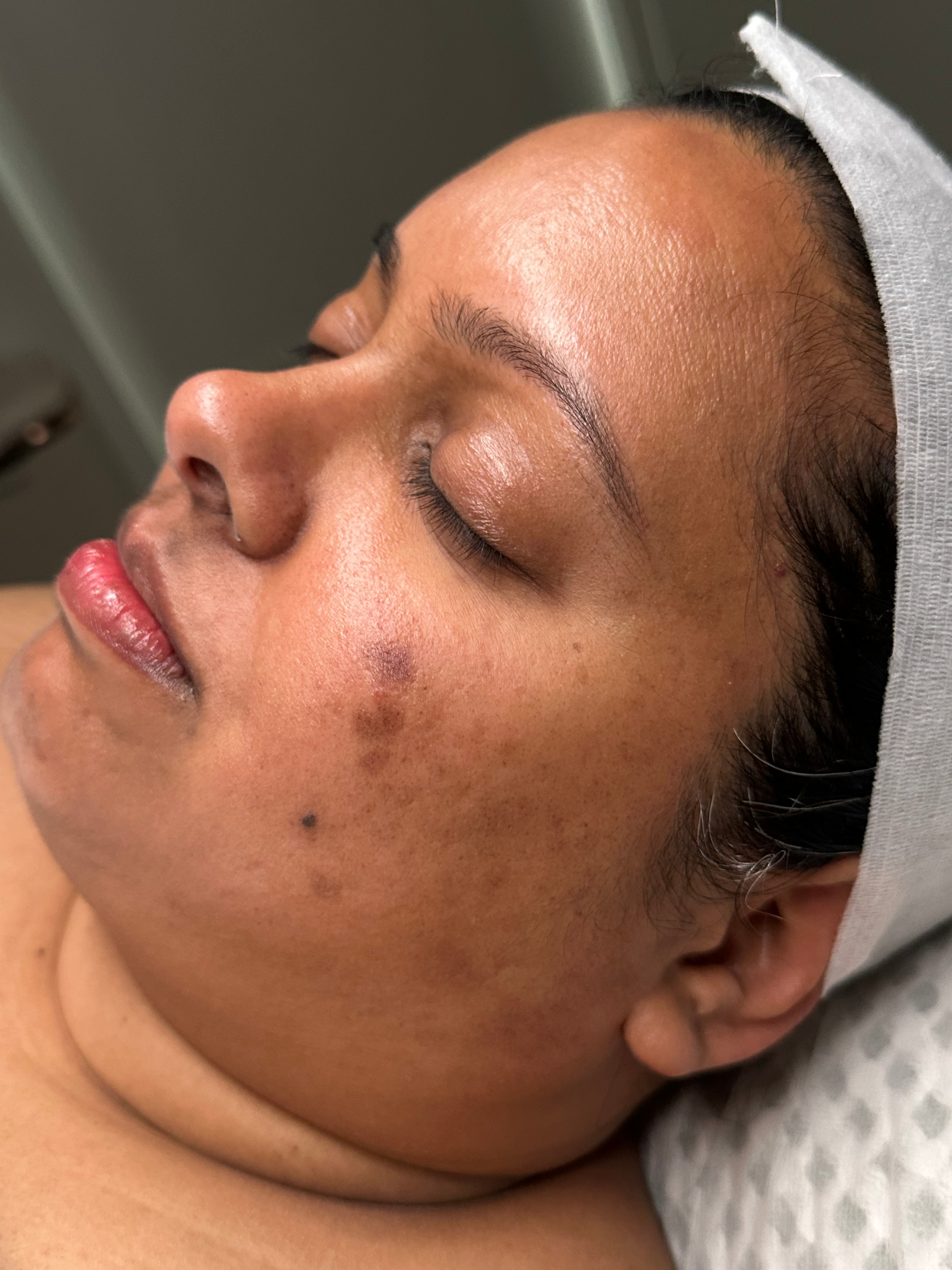 Pigmentation and uneven tone