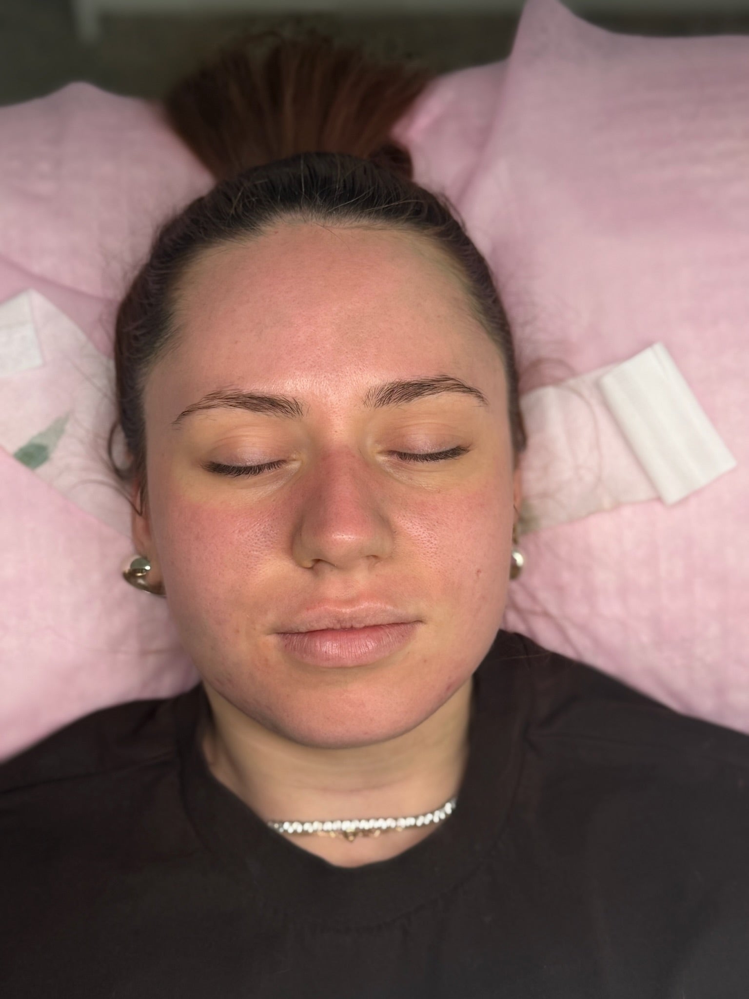 Long-term skin correction